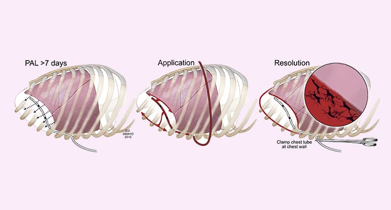 lung-ultrasound-treatmen