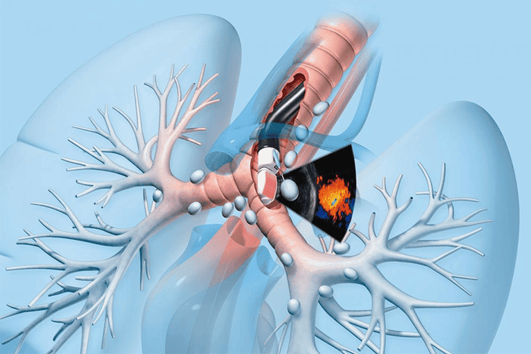 endobronchial-ultrasound-treatment