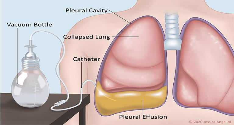 lung-ultrasound-treatmen