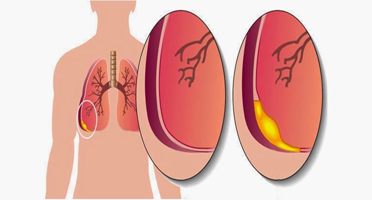 lung-ultrasound-treatmen